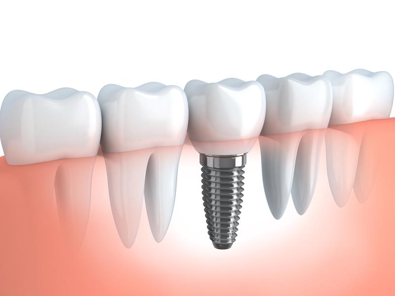 Dental Implants  Hyattsville, MD 